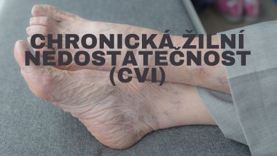 Chronická žilní nedostatečnost (CVI): Příznaky, příčiny, léčba a prevence | ARNO.cz - obuv s tradicí